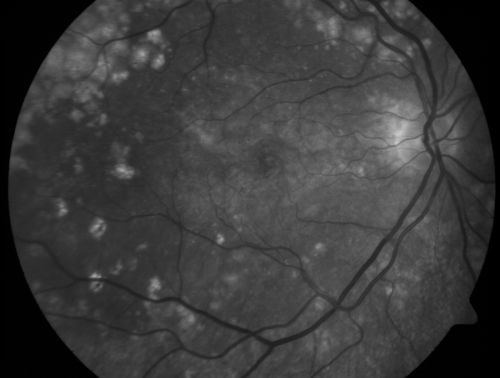 Basal Laminar Drusen - Cuticular Drusen - Equatorial Drusen - 70 Year Old Woman 
70 year old woman has had macular drusen since her thirties and she said her sister has a similar problem.  Recently the vision in the left eye has substantially declined. OD 20/16, OS 10/200.
