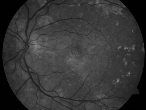 Basal Laminar Drusen - Cuticular Drusen - Equatorial Drusen - 70 Year Old Woman 
70 year old woman has had macular drusen since her thirties and she said her sister has a similar problem.  Recently the vision in the left eye has substantially declined. OD 20/16, OS 10/200.
