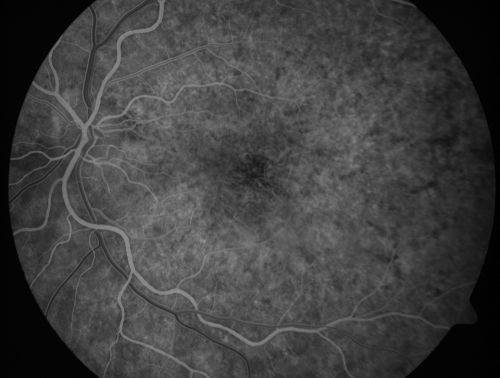 Basal Laminar Drusen - Cuticular Drusen - Equatorial Drusen - 70 Year Old Woman 
70 year old woman has had macular drusen since her thirties and she said her sister has a similar problem.  Recently the vision in the left eye has substantially declined. OD 20/16, OS 10/200.
