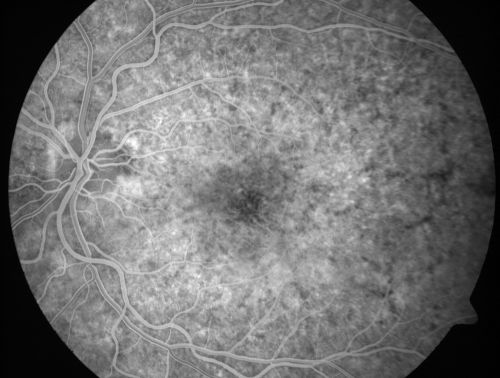 Basal Laminar Drusen - Cuticular Drusen - Equatorial Drusen - 70 Year Old Woman - Early FA Shows Cuticular Drusen like Stars
70 year old woman has had macular drusen since her thirties and she said her sister has a similar problem.  Recently the vision in the left eye has substantially declined. OD 20/16, OS 10/200.
