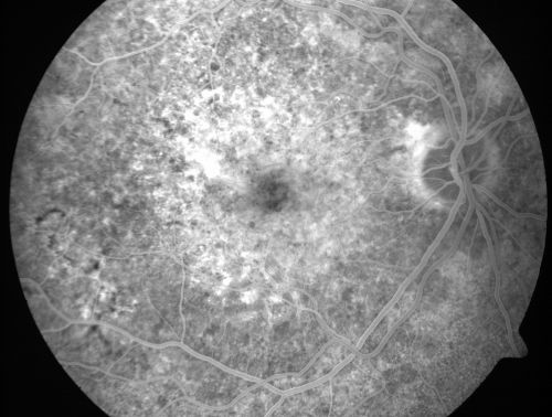 Basal Laminar Drusen - Cuticular Drusen - Equatorial Drusen - 70 Year Old Woman 
70 year old woman has had macular drusen since her thirties and she said her sister has a similar problem.  Recently the vision in the left eye has substantially declined. OD 20/16, OS 10/200.
