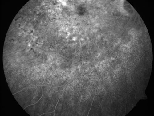 Basal Laminar Drusen - Cuticular Drusen - Equatorial Drusen - 70 Year Old Woman 
70 year old woman has had macular drusen since her thirties and she said her sister has a similar problem.  Recently the vision in the left eye has substantially declined. OD 20/16, OS 10/200.

