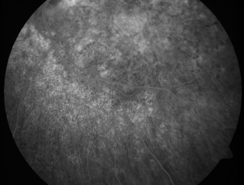 Basal Laminar Drusen - Cuticular Drusen - Equatorial Drusen - 70 Year Old Woman 
70 year old woman has had macular drusen since her thirties and she said her sister has a similar problem.  Recently the vision in the left eye has substantially declined. OD 20/16, OS 10/200.
