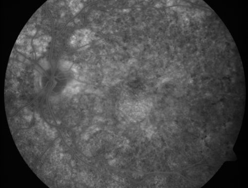 Basal Laminar Drusen - Cuticular Drusen - Equatorial Drusen - 70 Year Old Woman 
70 year old woman has had macular drusen since her thirties and she said her sister has a similar problem.  Recently the vision in the left eye has substantially declined. OD 20/16, OS 10/200.
