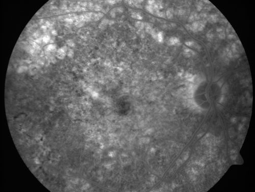Basal Laminar Drusen - Cuticular Drusen - Equatorial Drusen - 70 Year Old Woman 
70 year old woman has had macular drusen since her thirties and she said her sister has a similar problem.  Recently the vision in the left eye has substantially declined. OD 20/16, OS 10/200.
