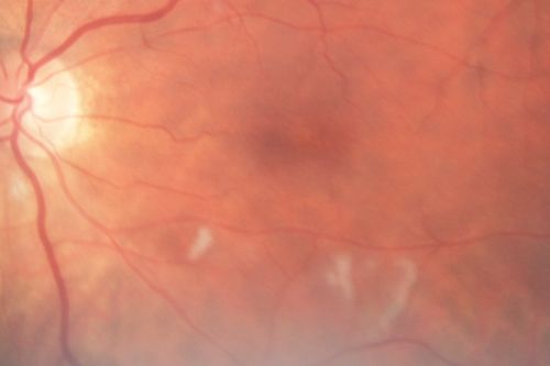 AIDS - HIV Retinopathy - Cotton Wool Spots
54-year-old woman HIV positive for 18 years.  Her CD4 count is currently less than 50 and she was hospitalized for pneumocystis carinii pneumonia 5 months ago. She has noticed just for the last few weeks a few blind spots in the paracentral vision.  Predominantly out of her right eye when she closes her left eye, she sees a few temporal blind spots. VA 20/25 in both eyes.  
