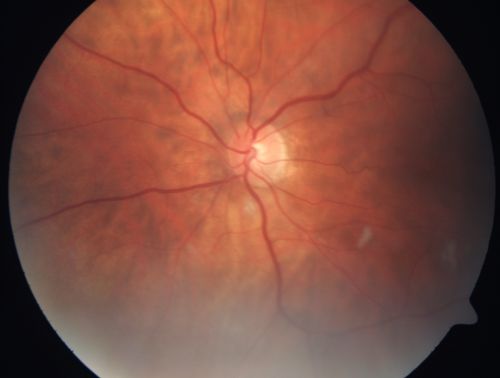 AIDS - HIV Retinopathy - Cotton Wool Spots
54-year-old woman HIV positive for 18 years.  Her CD4 count is currently less than 50 and she was hospitalized for pneumocystis carinii pneumonia 5 months ago. She has noticed just for the last few weeks a few blind spots in the paracentral vision.  Predominantly out of her right eye when she closes her left eye, she sees a few temporal blind spots. VA 20/25 in both eyes.  
