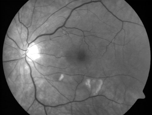 AIDS - HIV Retinopathy - Cotton Wool Spots
54-year-old woman HIV positive for 18 years.  Her CD4 count is currently less than 50 and she was hospitalized for pneumocystis carinii pneumonia 5 months ago. She has noticed just for the last few weeks a few blind spots in the paracentral vision.  Predominantly out of her right eye when she closes her left eye, she sees a few temporal blind spots. VA 20/25 in both eyes.  
