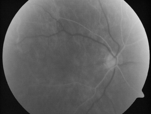 AIDS - HIV Retinopathy - Cotton Wool Spots
54-year-old woman HIV positive for 18 years.  Her CD4 count is currently less than 50 and she was hospitalized for pneumocystis carinii pneumonia 5 months ago. She has noticed just for the last few weeks a few blind spots in the paracentral vision.  Predominantly out of her right eye when she closes her left eye, she sees a few temporal blind spots. VA 20/25 in both eyes.  
