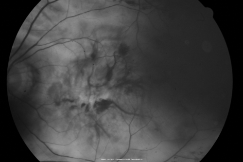 Polypoidal Choroidal Vasculopathy Right Eye - Disciform Scar Left Eye
84-year-old woman has polypoidal choroidal vasculopathy in both eyes with macular degeneration.  She has macular scars in both eyes and she remains with remarkably good vision in the right eye despite the scarring.  

VISUAL ACUITY:  OD 20/30,  OS 1/200

Avastin Rx OD
