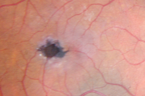Juxtafoveal Telangiectasis - MacTel - Group 2a - Stage IV - Pigment Plaque 89 Year Old Man
89-year-old man has stage IV  juxtafoveal retinal telangiectasis in both eyes with background diabetic retinopathy.  His vision is stable since he was here last which is about 6 months ago. OD 20/50,  OS 20/70.
