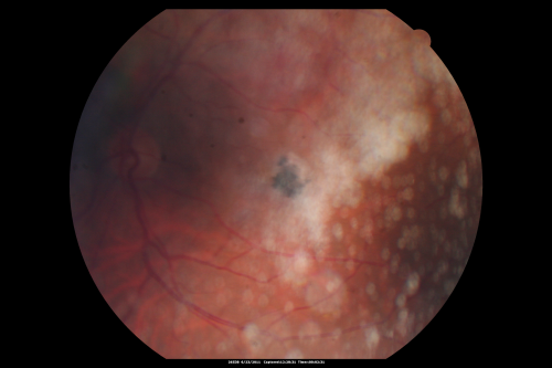 Juxtafoveal Telangiectasis - MacTel - Group 2a - Stage IV - Pigment Plaque 89 Year Old Man - Asteroid Hyalosis
89-year-old man has stage IV  juxtafoveal retinal telangiectasis in both eyes with background diabetic retinopathy.  His vision is stable since he was here last which is about 6 months ago. OD 20/50,  OS 20/70.
