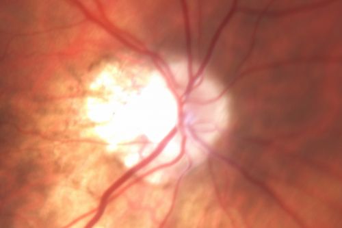 Optic Atrophy - Probably Dominant
76-year-old woman decreased vision for at least 40 years.  She said she was told she had optic atrophy at Bascom Palmer in the 1970s.  She does not know if she has optic atrophy in her family.  VA 20/400 in each eye.

