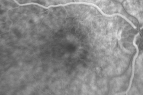 Pattern Dystrophy - Adult Vitelliform Dystrophy - Macular Degeneration
 78 Year Old Woman with vision has diminished in the right eye over the past couple of years, but the diminishment has been slow.
 20/60+1 OD, 20/25 OS
