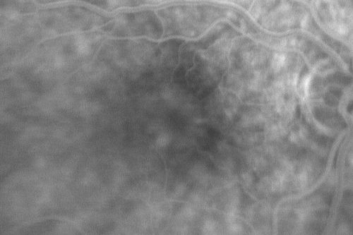 Pattern Dystrophy - Adult Vitelliform Dystrophy - Macular Degeneration
 78 Year Old Woman with vision has diminished in the right eye over the past couple of years, but the diminishment has been slow.
 20/60+1 OD, 20/25 OS
