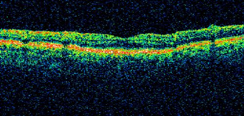 Pattern Dystrophy - Adult Vitelliform Dystrophy - Macular Degeneration
 78 Year Old Woman with vision has diminished in the right eye over the past couple of years, but the diminishment has been slow.
 20/60+1 OD, 20/25 OS
