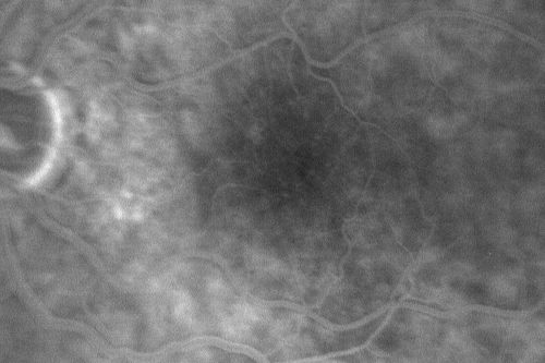 Pattern Dystrophy - Adult Vitelliform Dystrophy - Macular Degeneration
 78 Year Old Woman with vision has diminished in the right eye over the past couple of years, but the diminishment has been slow.
 20/60+1 OD, 20/25 OS
