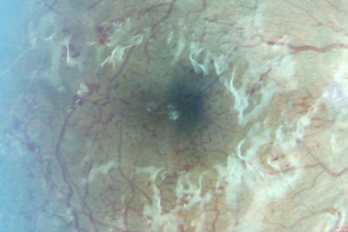 Capillary Non-Perfusion - Severe Non-Proliferative (Background) Diabetic Retinopathy - Type I - 20 Year Old Man Diabetic 16 years
20 year old diabetic with poor vision for the past three or four years. He has been diabetic for sixteen years and hemoglobin A1C of 10.0.   20/25 OD, 20/30 OS.  
