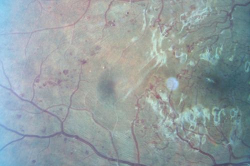 Capillary Non-Perfusion - Severe Non-Proliferative (Background) Diabetic Retinopathy - Type I - 20 Year Old Man Diabetic 16 years
20 year old diabetic with poor vision for the past three or four years. He has been diabetic for sixteen years and hemoglobin A1C of 10.0.   20/25 OD, 20/30 OS.  

