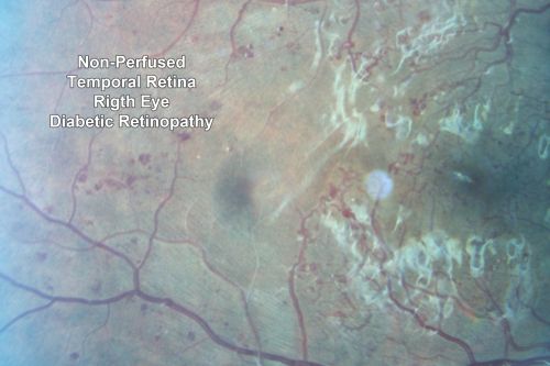 Capillary Non-Perfusion - Severe Non-Proliferative (Background) Diabetic Retinopathy - Type I - 20 Year Old Man Diabetic 16 years
20 year old diabetic with poor vision for the past three or four years. He has been diabetic for sixteen years and hemoglobin A1C of 10.0.   20/25 OD, 20/30 OS.  

