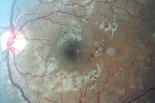 Capillary Non-Perfusion - Severe Non-Proliferative (Background) Diabetic Retinopathy - Type I - 20 Year Old Man Diabetic 16 years
20 year old diabetic with poor vision for the past three or four years. He has been diabetic for sixteen years and hemoglobin A1C of 10.0.   20/25 OD, 20/30 OS.  
