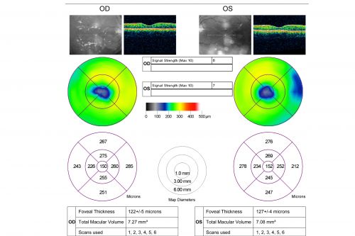 Capillary Non-Perfusion - Severe Non-Proliferative (Background) Diabetic Retinopathy - Type I - 20 Year Old Man Diabetic 16 years
20 year old diabetic with poor vision for the past three or four years. He has been diabetic for sixteen years and hemoglobin A1C of 10.0.   20/25 OD, 20/30 OS.  
