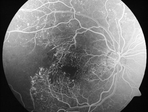 Capillary Non-Perfusion - Severe Non-Proliferative (Background) Diabetic Retinopathy - Type I - 20 Year Old Man Diabetic 16 years
20 year old diabetic with poor vision for the past three or four years. He has been diabetic for sixteen years and hemoglobin A1C of 10.0.   20/25 OD, 20/30 OS.  
