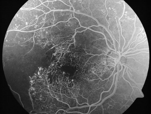 Capillary Non-Perfusion - Severe Non-Proliferative (Background) Diabetic Retinopathy - Type I - 20 Year Old Man Diabetic 16 years
20 year old diabetic with poor vision for the past three or four years. He has been diabetic for sixteen years and hemoglobin A1C of 10.0.   20/25 OD, 20/30 OS.  
