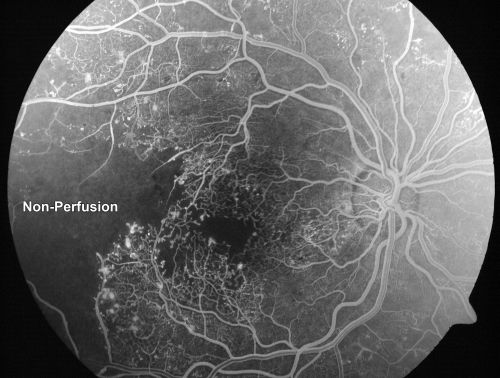 Capillary Non-Perfusion - Severe Non-Proliferative (Background) Diabetic Retinopathy - Type I - 20 Year Old Man Diabetic 16 years
20 year old diabetic with poor vision for the past three or four years. He has been diabetic for sixteen years and hemoglobin A1C of 10.0.   20/25 OD, 20/30 OS.  
