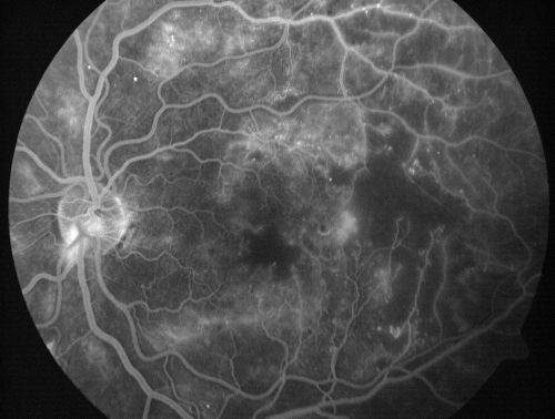 Capillary Non-Perfusion - Severe Non-Proliferative (Background) Diabetic Retinopathy - Type I - 20 Year Old Man Diabetic 16 years
20 year old diabetic with poor vision for the past three or four years. He has been diabetic for sixteen years and hemoglobin A1C of 10.0.   20/25 OD, 20/30 OS.  
