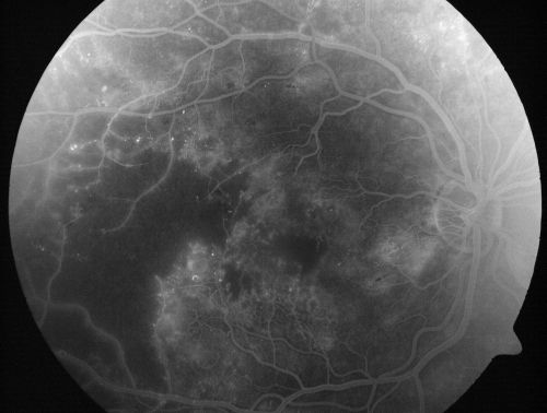 Capillary Non-Perfusion - Severe Non-Proliferative (Background) Diabetic Retinopathy - Type I - 20 Year Old Man Diabetic 16 years
20 year old diabetic with poor vision for the past three or four years. He has been diabetic for sixteen years and hemoglobin A1C of 10.0.   20/25 OD, 20/30 OS.  
