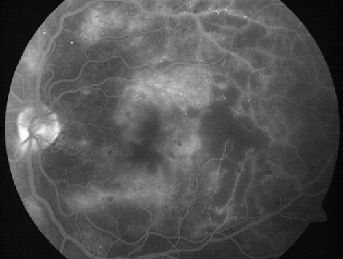 Capillary Non-Perfusion - Severe Non-Proliferative (Background) Diabetic Retinopathy - Type I - 20 Year Old Man Diabetic 16 years
20 year old diabetic with poor vision for the past three or four years. He has been diabetic for sixteen years and hemoglobin A1C of 10.0.   20/25 OD, 20/30 OS.  
