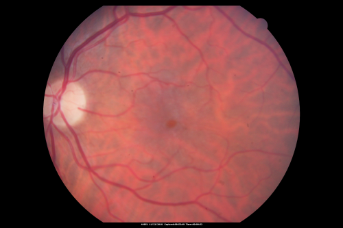 Radiation Retinopathy and Macular Pucker 4 years following Brachytherapy (Plaque) for Nasal Melanoma
67-year-old woman has a macular pucker in the left eye.  She had radiation for a melanoma in that eye 4 years aog.  She had cataract surgery 2 years ago and a posterior sub-Tenon Kenalog injection in 7 months ago.  Her vision in the left eye is hazy and she has trouble seeing out of it.  VA  OS 20/70. 
