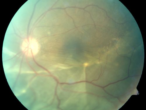 Chronic Retinal Detachment - Pigment Line - Subretinal Fibrosis
60 year old with temporal macula-on chronic retinal detachment.  No treatment was done.

