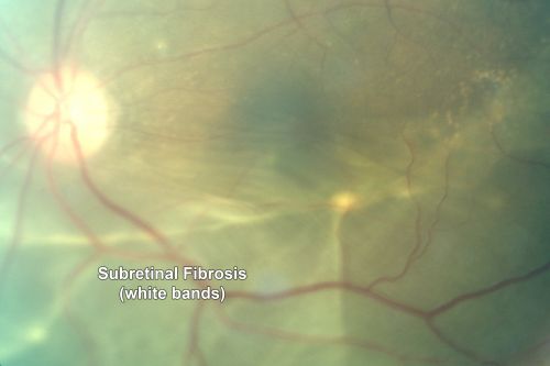 Chronic Retinal Detachment - Pigment Line - Subretinal Fibrosis
60 year old with temporal macula-on chronic retinal detachment.  No treatment was done.
