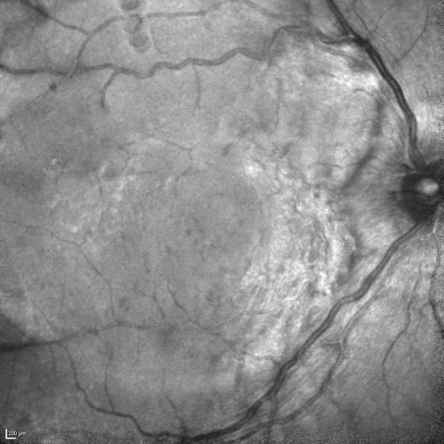 Vitreomacular Traction 3 months - 20/60 vision - Fellow Eye Normal - 80 Year Old Man - Red Free
80-year-old man has a macular pucker in the right eye with vitreomacular traction and vision loss for 3 months.  His vision seems about stable to him.   OD 20/60.
