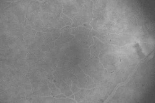 Vitreomacular Traction 1 month - 20/60 vision - Fellow Eye Normal - 80 Year Old Man 
80-year-old man has a macular pucker in the right eye with vitreomacular traction and vision loss for 1 month.  His vision seems about stable to him.   OD 20/60.
(these images are from initial presentation)
