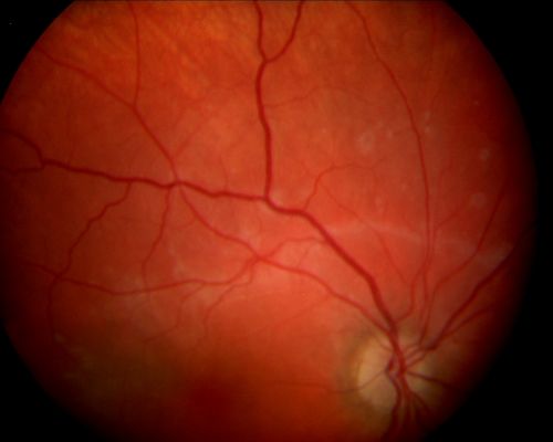 Acute Annular Outer Retinopathy  - VA loss 2 days Right Eye Only - 25 Year Old Woman
Initial visit (June 11, 2011): 2 days of vision loss right eye.  Wedge suddenly of VA loss OD, too dardkto see through.  No flashes or floaters.  VA 20/20 OU.


Keywords: MEWDS;AZOOR;white dot;acute;zonal;occult