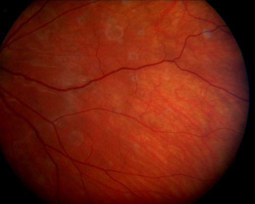 Acute Annular Outer Retinopathy  - VA loss 2 days Right Eye Only - 25 Year Old Woman
Initial visit (June 11, 2011): 2 days of vision loss right eye.  Wedge suddenly of VA loss OD, too dardkto see through.  No flashes or floaters.  VA 20/20 OU.


Keywords: MEWDS;AZOOR;white dot;acute;zonal;occult
