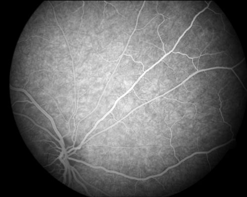 Acute Annular Outer Retinopathy  - VA loss 2 days Right Eye Only - 25 Year Old Woman
Initial visit (June 11, 2011): 2 days of vision loss right eye.  Wedge suddenly of VA loss OD, too dardkto see through.  No flashes or floaters.  VA 20/20 OU.


Keywords: MEWDS;AZOOR;white dot;acute;zonal;occult
