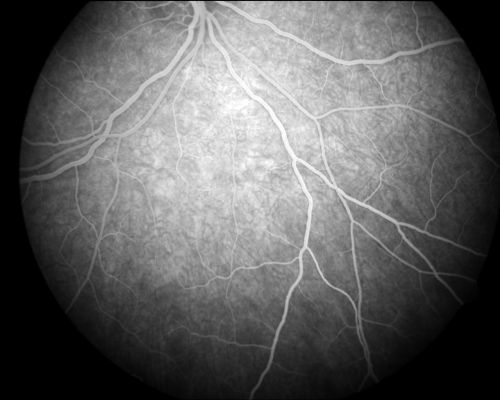 Acute Annular Outer Retinopathy  - VA loss 2 days Right Eye Only - 25 Year Old Woman
Initial visit (June 11, 2011): 2 days of vision loss right eye.  Wedge suddenly of VA loss OD, too dardkto see through.  No flashes or floaters.  VA 20/20 OU.


Keywords: MEWDS;AZOOR;white dot;acute;zonal;occult