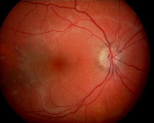 Acute Annular Outer Retinopathy - VA loss 2 days Right Eye Only - 25 Year Old Woman- AZOOR - White Line Around Fresh Lesions
Initial visit (June 11, 2011): 2 days of vision loss right eye.  Wedge suddenly of VA loss OD, too dardkto see through.  No flashes or floaters.  VA 20/20 OU.


Keywords: MEWDS;AZOOR;white dot;acute;zonal;occult