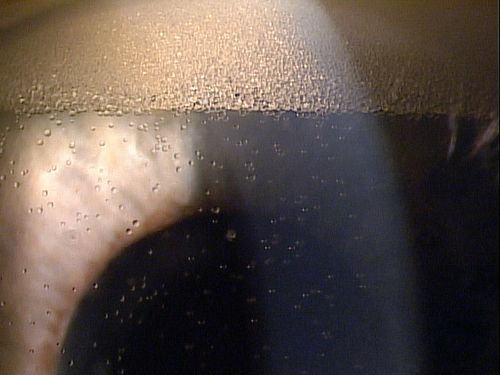 Emulsified silicone oil in anterior chamger
Keywords: july2012