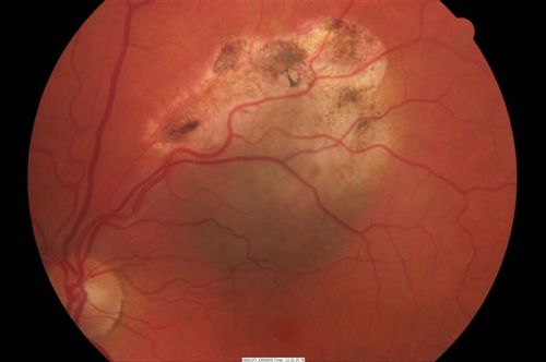 Recurrence of Melanoma after Transpupillary Thermotherapy
3 previous episodes of TTT. This recurrence occurred 1 year later
