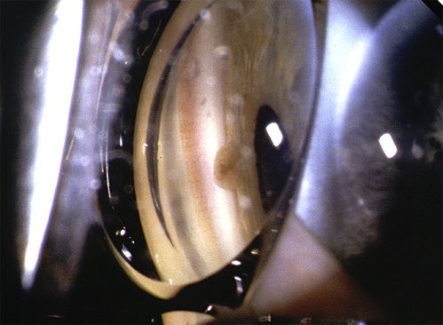 Juvenile Xanthogranuloma
Presented with hyphaema after minor trauma
Keywords: Juvenile Xanthogranuloma;JXG
