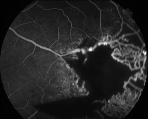 Coats' Disease in 14 Year Old Boy Treated with Cryotherapy and Avastin
14 Year Old Boy with Coats Disease
Keywords: feb2012