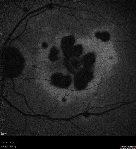 RETINA_CHORIORETINITS_AUTOF_OS_GatesC.jpg