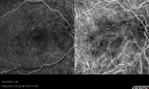 RETINA_CHORIORETINITS_EARLY_FA_ICG_GatesC.jpg