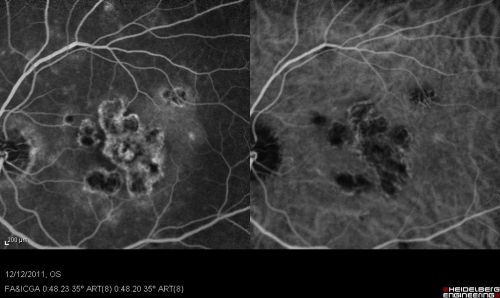 RETINA_CHORIORETINITS_EARLY_FA_ICG_OS_GatesC.jpg