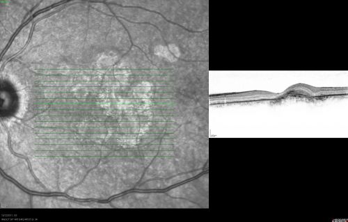 RETINA_CHORIORETINITS_OCT_OS_GatesC.jpg